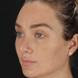 Browlift Before & After Patient #1297