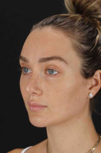 Browlift Before & After Patient #1297
