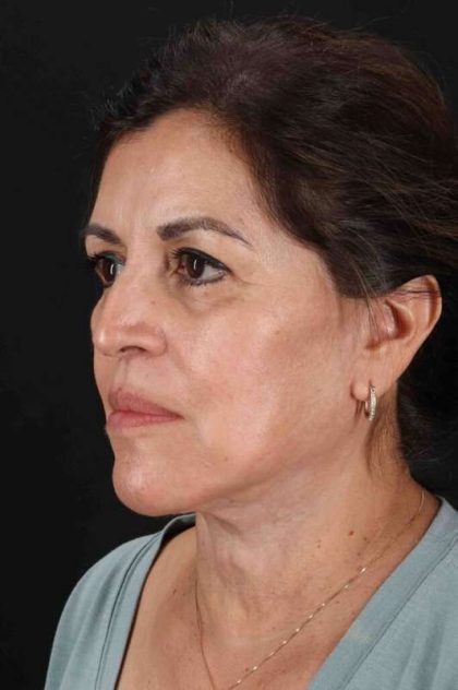 Lower Blepharoplasty Before & After Patient #2343