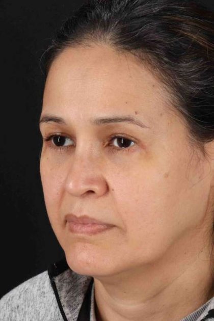 Lower Blepharoplasty Before & After Patient #2365