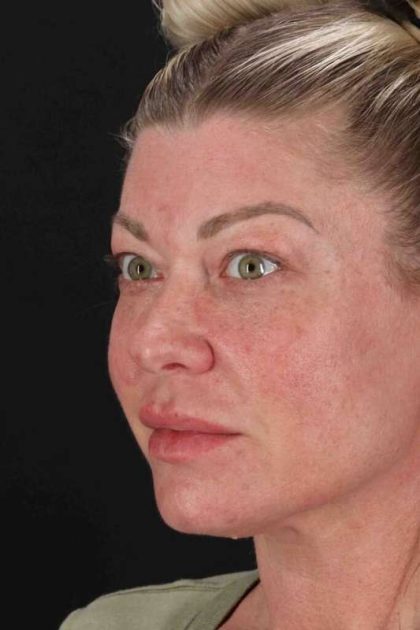 Lower Blepharoplasty Before & After Patient #2387