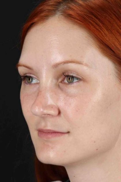 Lower Blepharoplasty Before & After Patient #2409