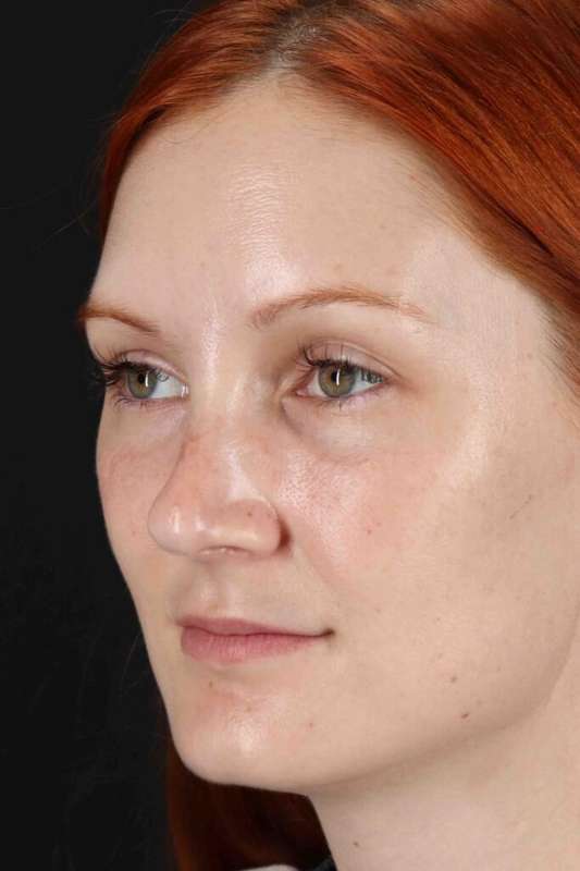 Lower Blepharoplasty Before & After Patient #2409