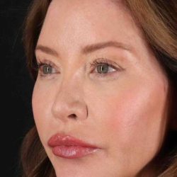 Browlift Before & After Patient #1308