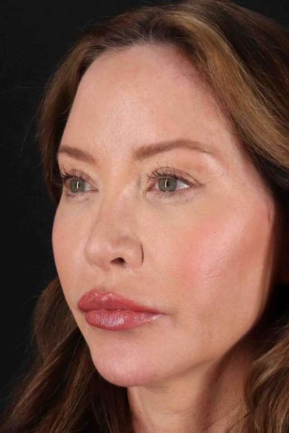 Browlift Before & After Patient #1308