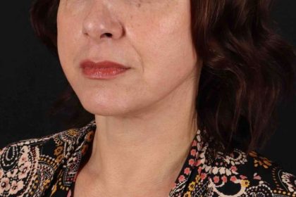 Neck Lift Before & After Patient #2472