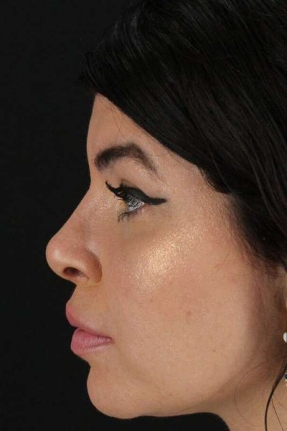 Browlift Before & After Patient #1220