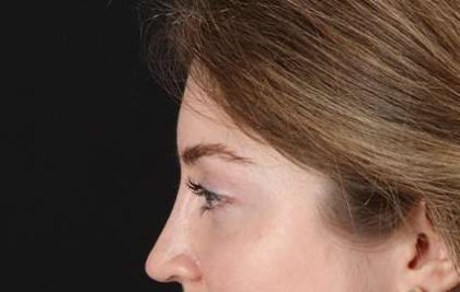 Browlift Before & After Patient #1319