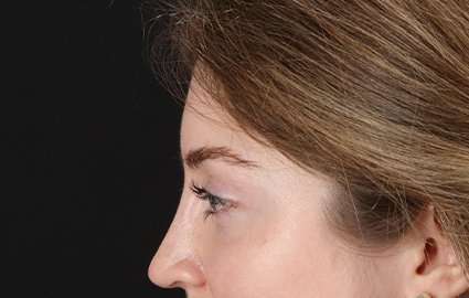 Browlift Before & After Patient #1319