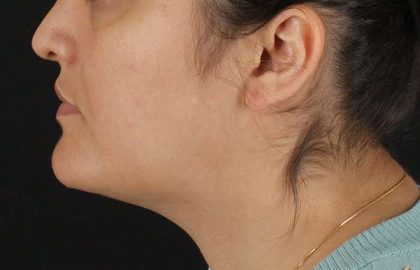 Neck Lift Before & After Patient #2560
