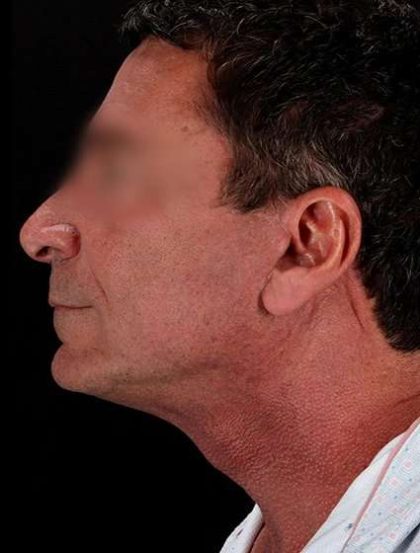 Neck Lift Before & After Patient #2604