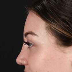 Browlift Before & After Patient #1330