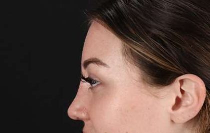 Browlift Before & After Patient #1330
