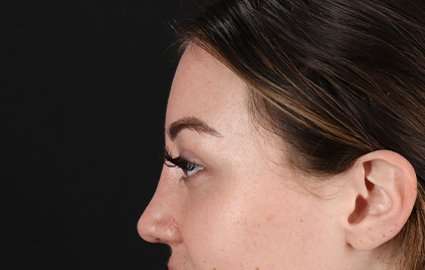 Browlift Before & After Patient #1330