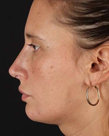 Neck Liposuction Before & After Patient #2719