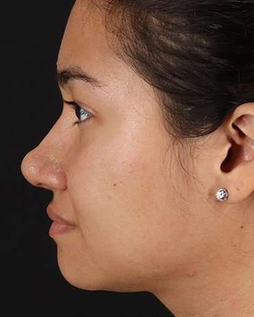 Neck Liposuction Before & After Patient #2730