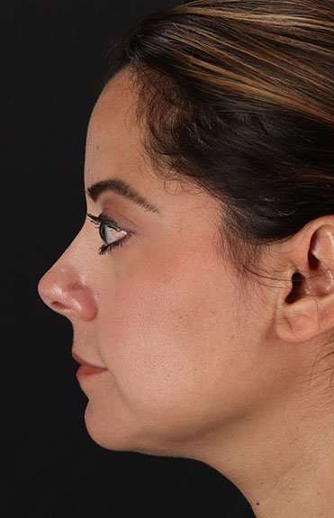 Neck Liposuction Before & After Patient #2752