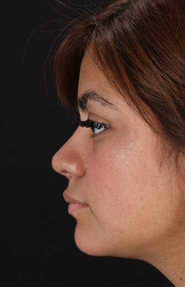 Neck Liposuction Before & After Patient #2763