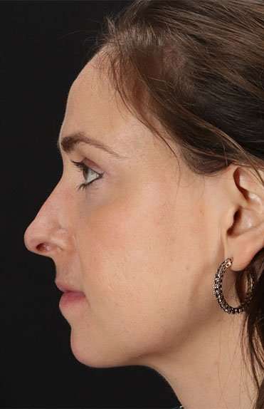 Neck Liposuction Before & After Patient #2785