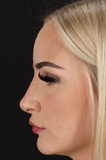Rhinoplasty Before & After Patient #2807