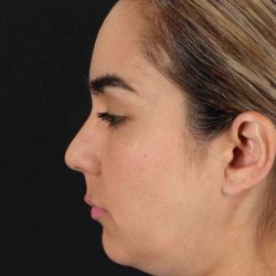 Browlift Before & After Patient #1341