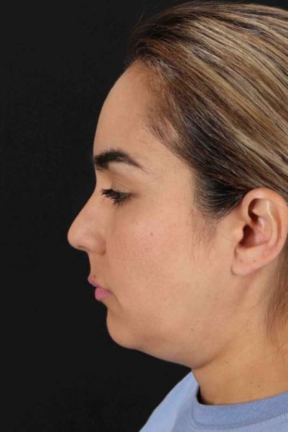 Browlift Before & After Patient #1341