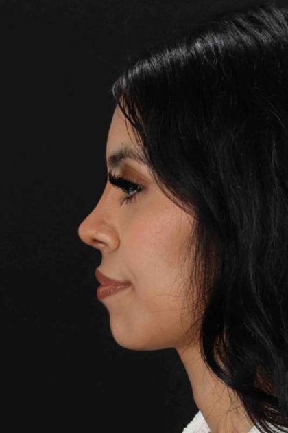 Rhinoplasty Before & After Patient #2818