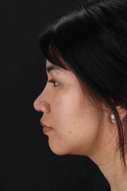 Rhinoplasty Before & After Patient #2829