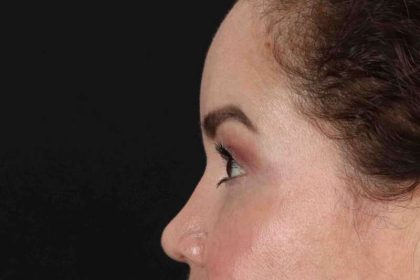 Rhinoplasty Before & After Patient #2840
