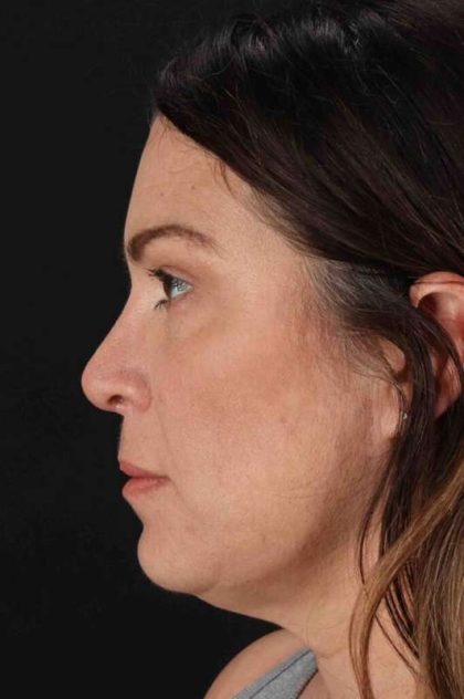 Rhinoplasty Before & After Patient #2851