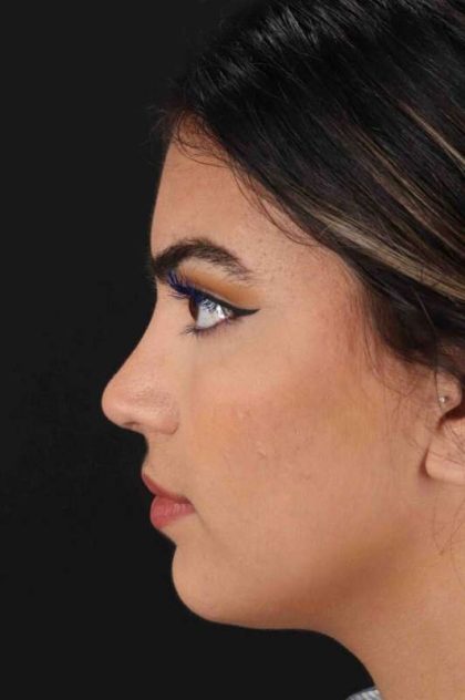Rhinoplasty Before & After Patient #2862