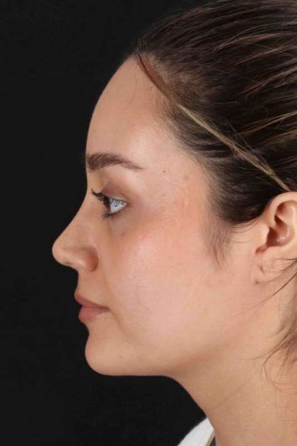 Rhinoplasty Before & After Patient #2873