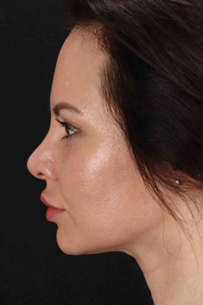 Rhinoplasty Before & After Patient #2884