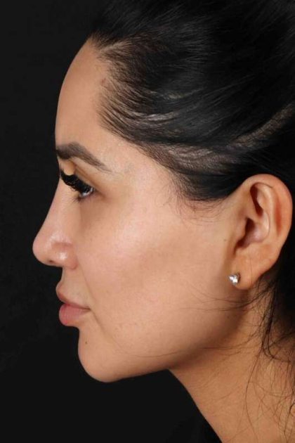 Rhinoplasty Before & After Patient #2895