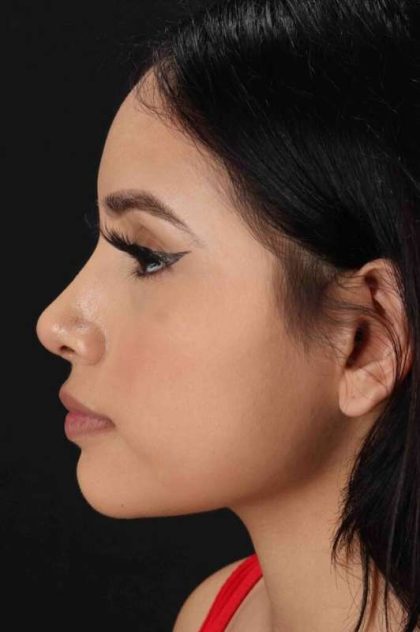 Rhinoplasty Before & After Patient #2917