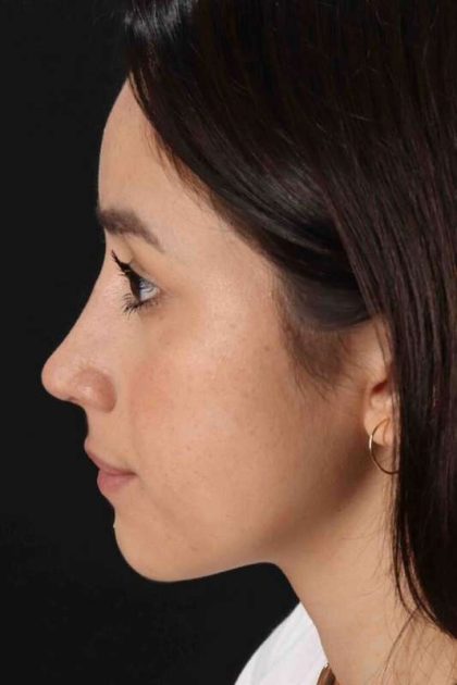 Rhinoplasty Before & After Patient #2928