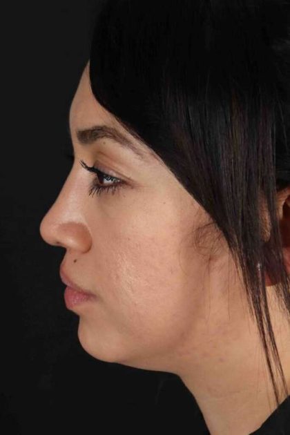 Rhinoplasty Before & After Patient #2939