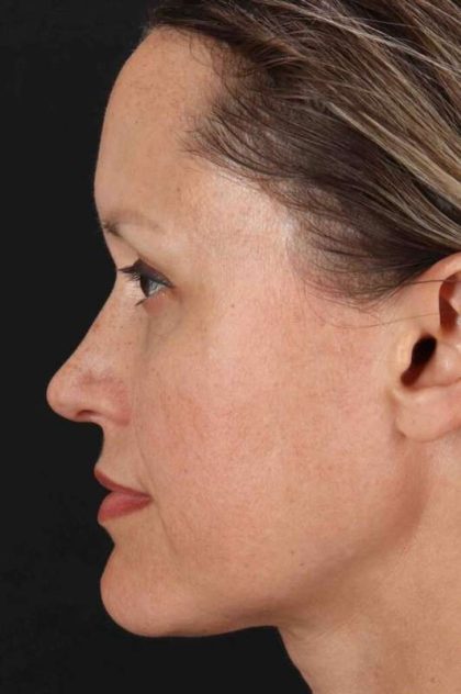 Rhinoplasty Before & After Patient #2950