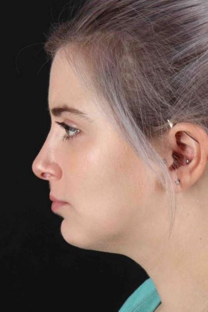 Rhinoplasty Before & After Patient #2961