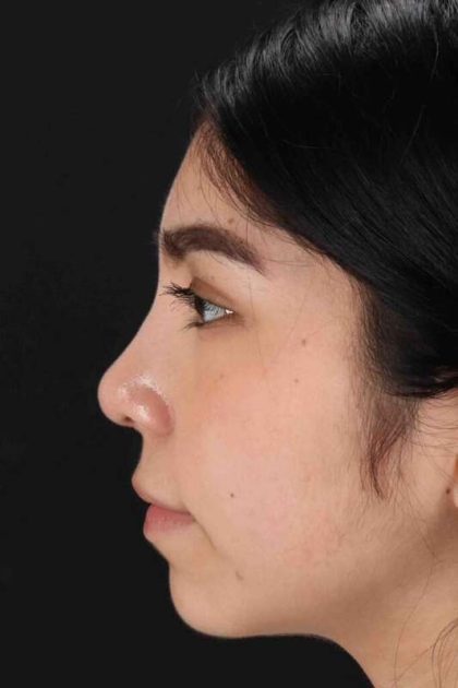 Rhinoplasty Before & After Patient #2972