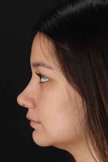 Rhinoplasty Before & After Patient #2983