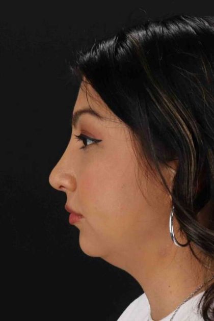 Rhinoplasty Before & After Patient #2994