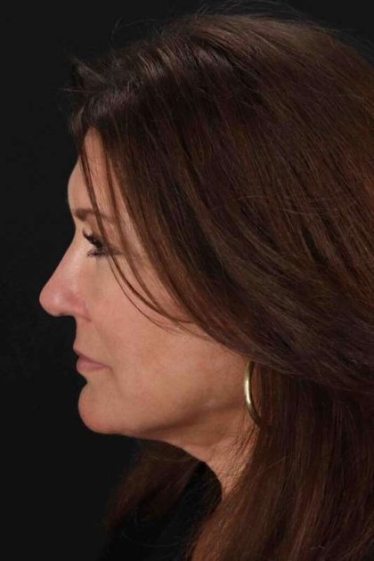 Rhinoplasty Before & After Patient #3005
