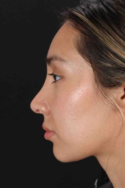 Rhinoplasty Before & After Patient #3027