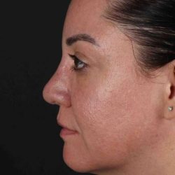 Browlift Before & After Patient #1363