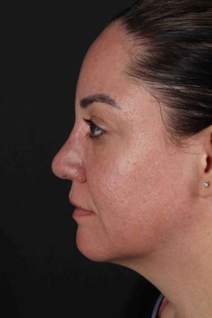 Browlift Before & After Patient #1363