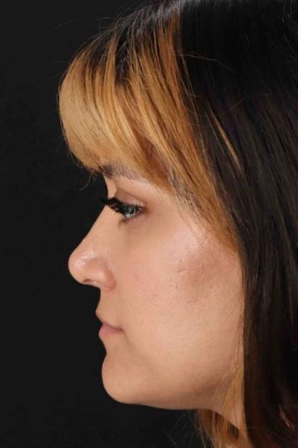 Rhinoplasty Before & After Patient #3038