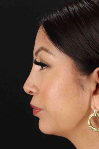 Rhinoplasty Before & After Patient #3049