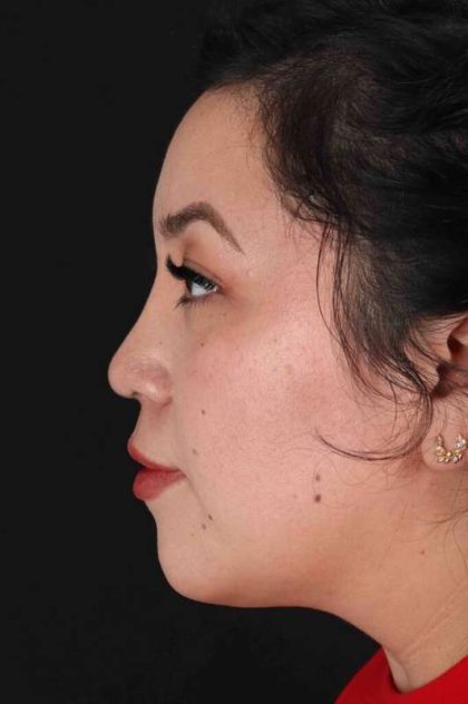 Rhinoplasty Before & After Patient #3060