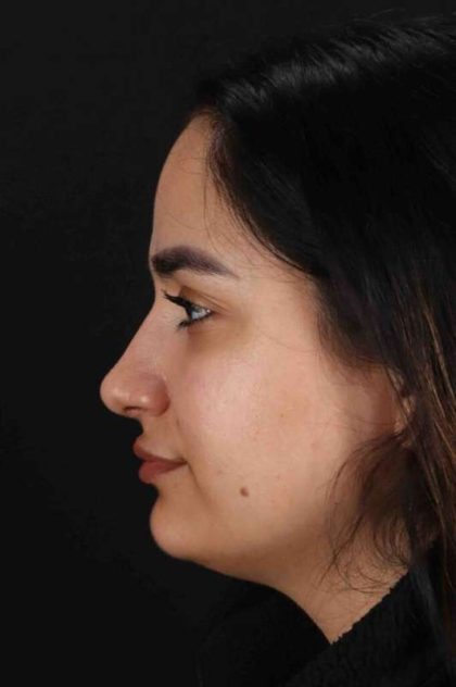 Rhinoplasty Before & After Patient #3071